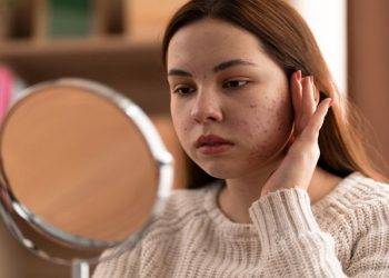 Rosacea: Causes, Symptoms, Treatment